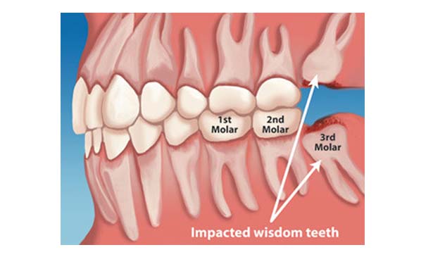 [DIAGRAM] Diagram Of Wisdom Teeth - MYDIAGRAM.ONLINE